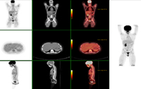 PET/CT