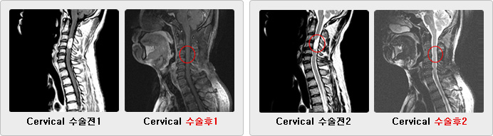Cervical Ä¡·áÀü Ä¡·áÈÄ»çÁø